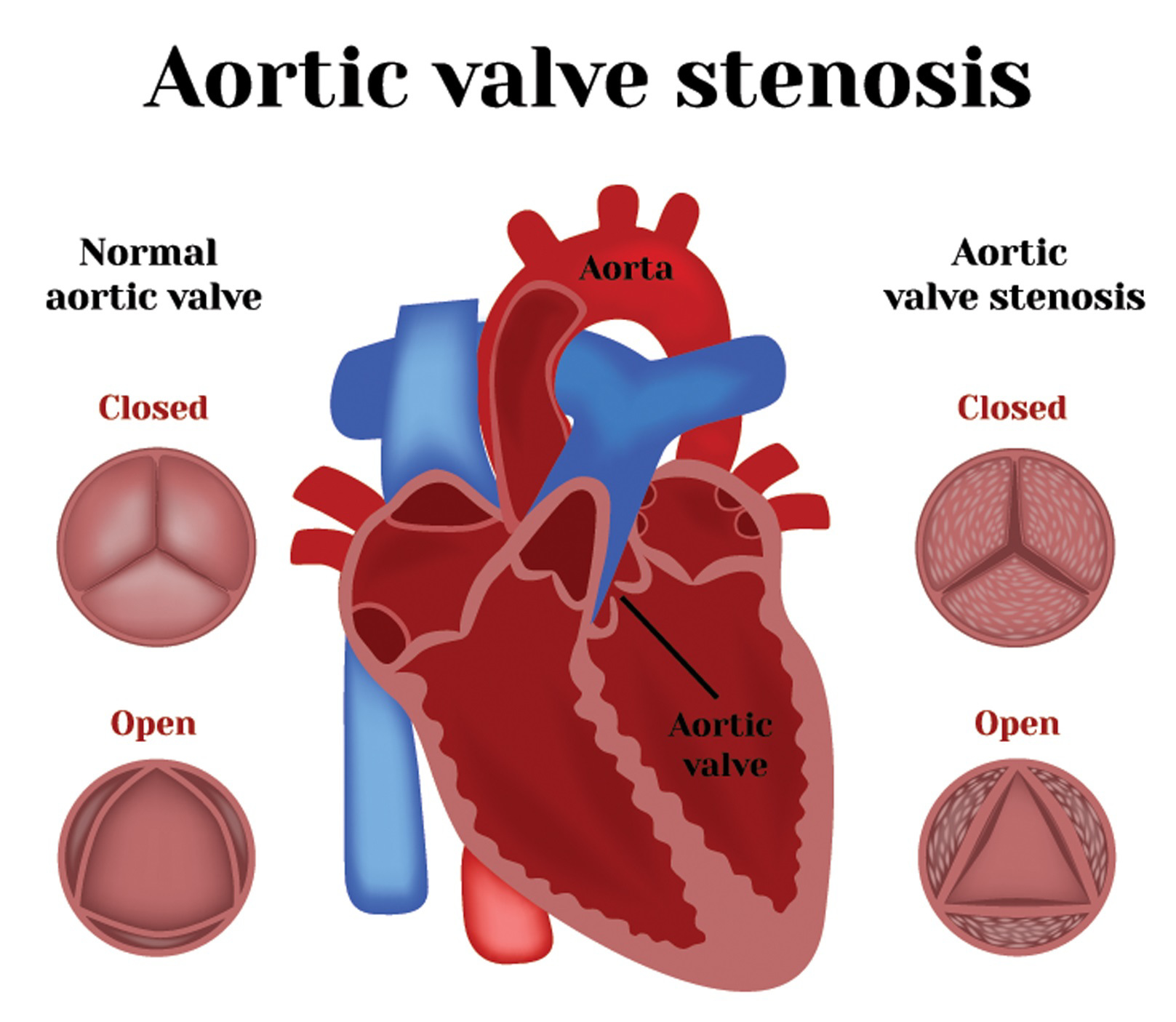 Aortic Valve Stenosis