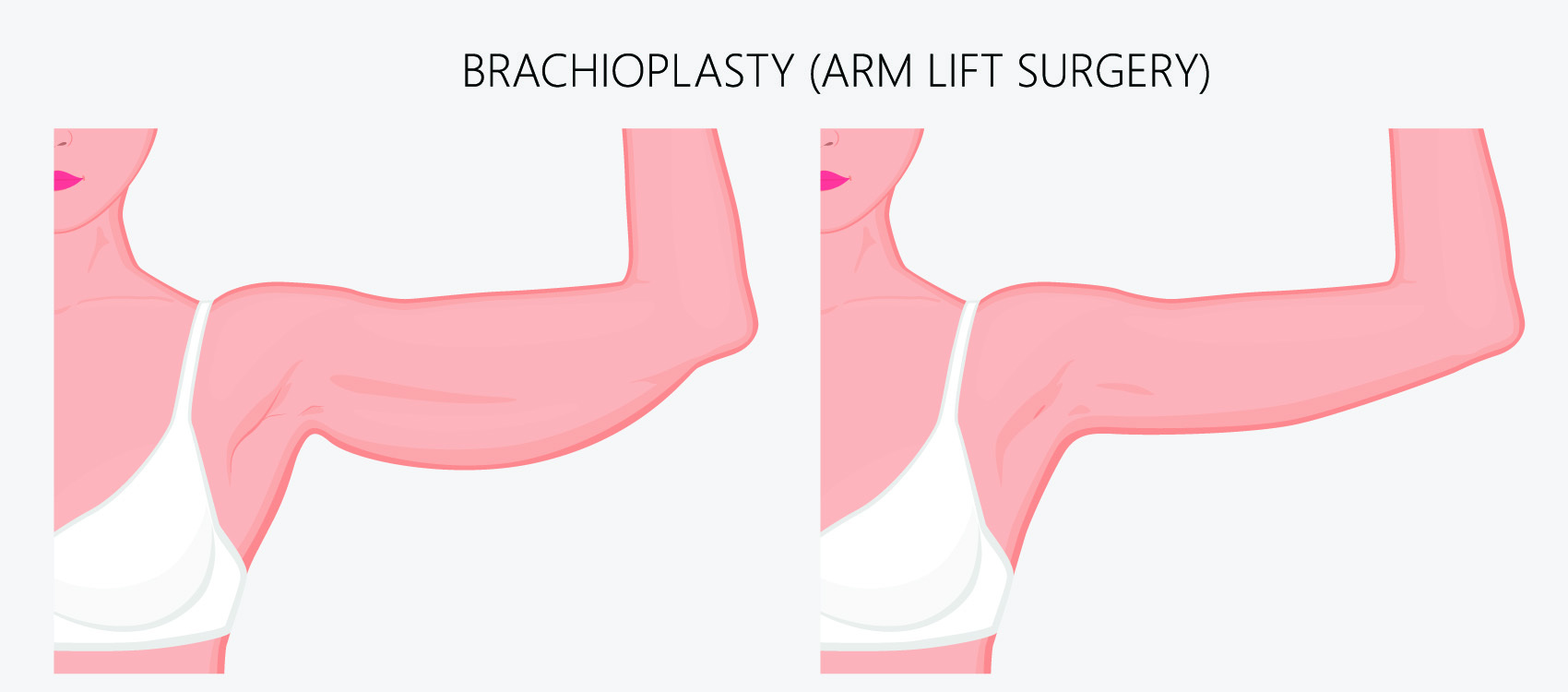 Brachioplasty