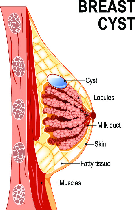 ovarian-cysts-during-menopause-menopause-now