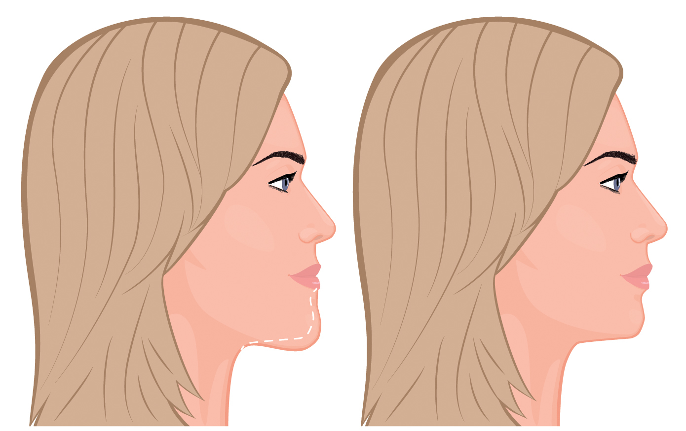 chin-reduction