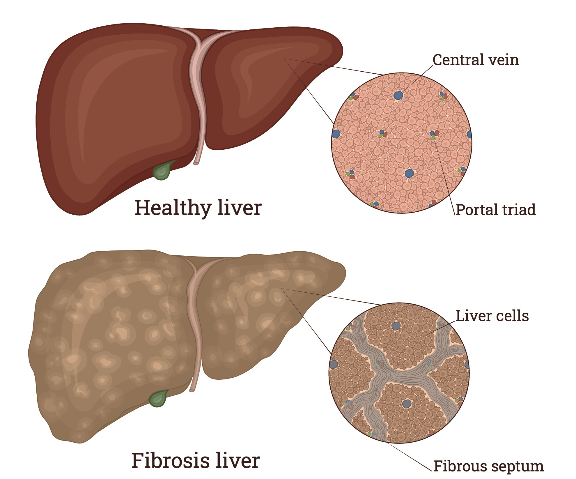 Liver Fibrosis