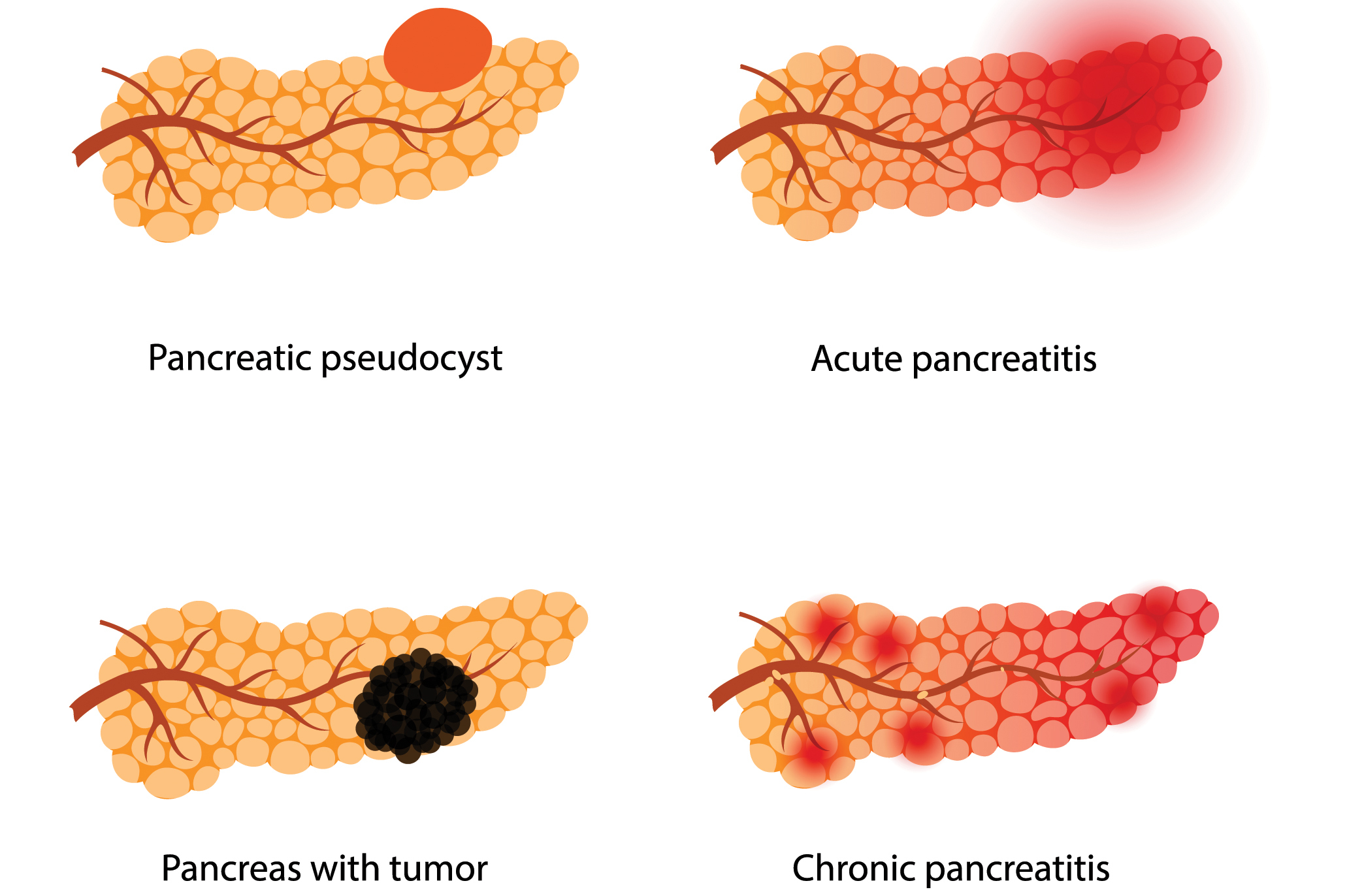 treating-pancreatic-cancer-symptoms-pancreatic-cancer-awareness-pca