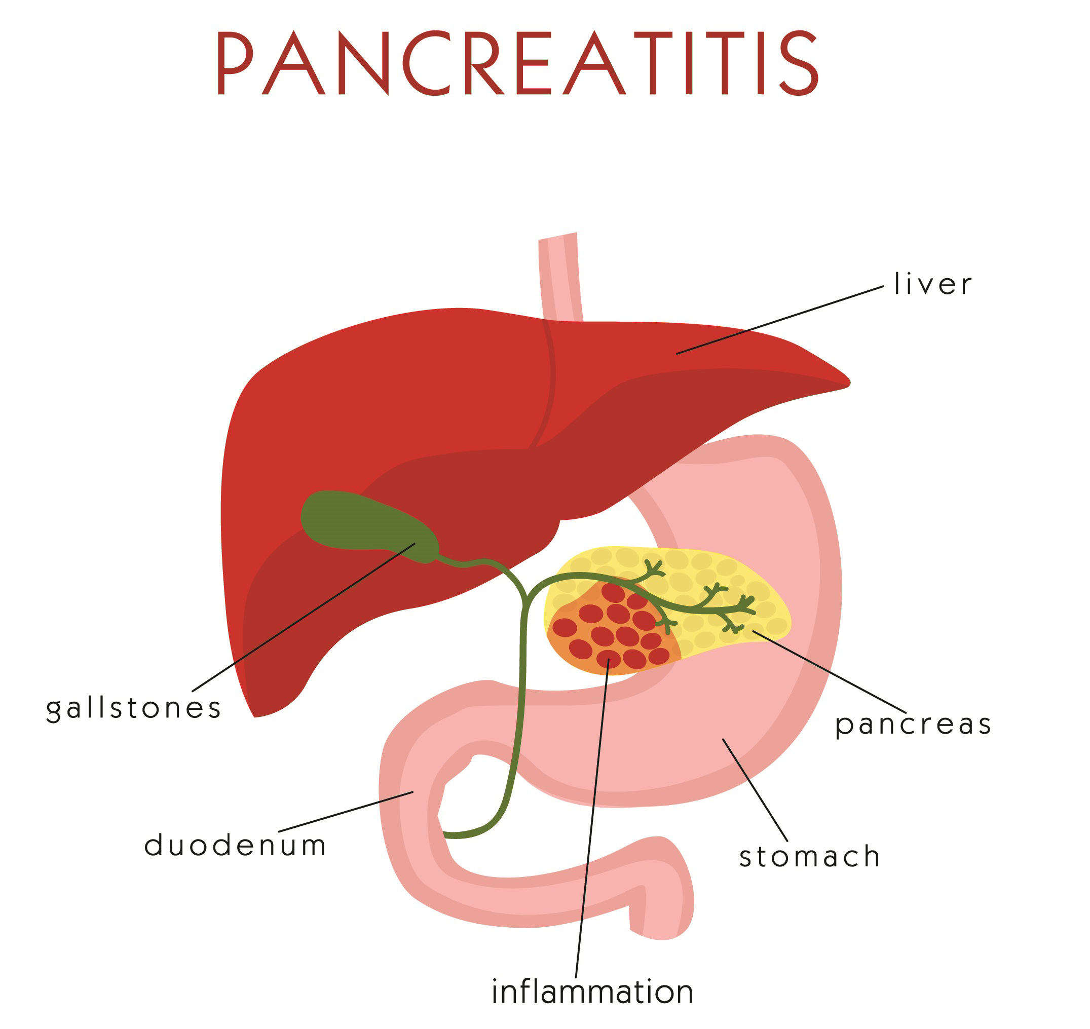 pancreatitis