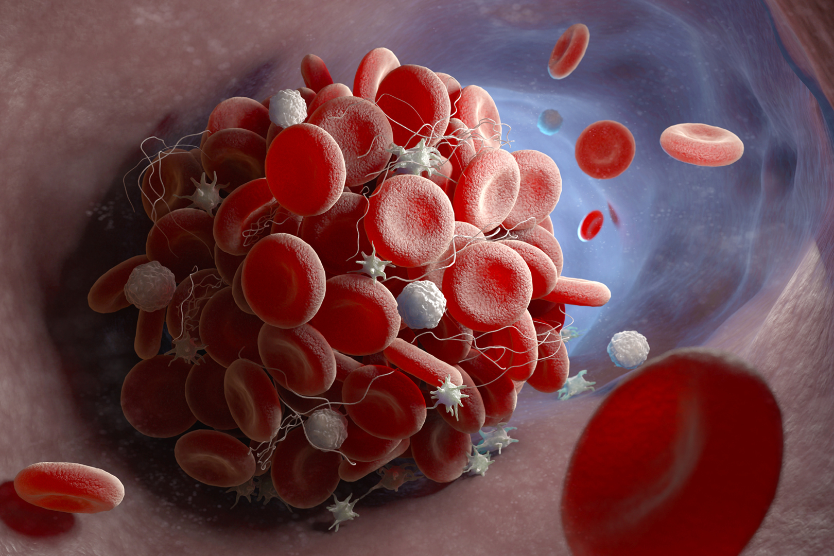 Thrombocytopenia Overview of