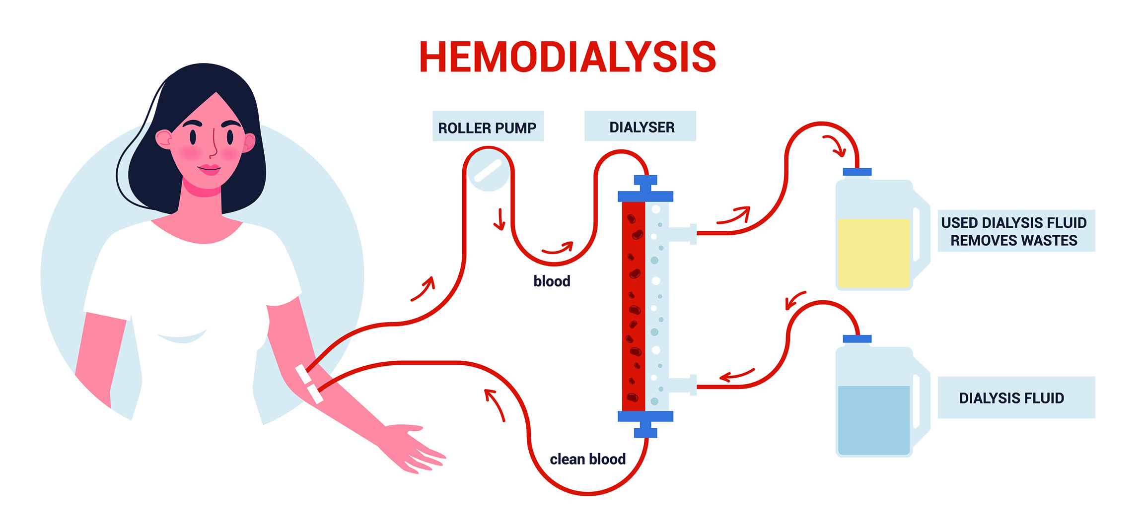 Hemodialysis and 3 Nursing Care Plans for Hemodialysis.