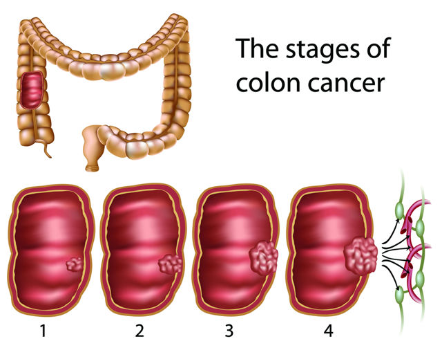 Signs and Symptoms of Colon Cancer 