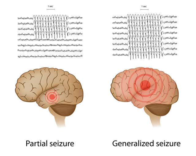 Signs and Symptoms of Epilepsy 