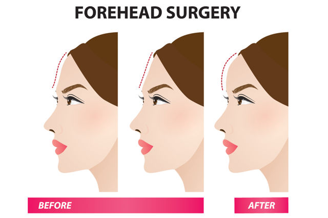 Forehead Implant Procedure 