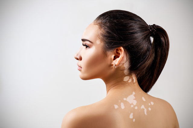 Signs and Symptoms of Vitiligo 
