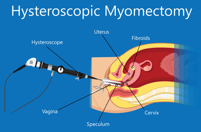 Hysteroscopic myomectomy