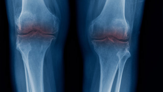 Diagnóstico de la artritis degenerativa